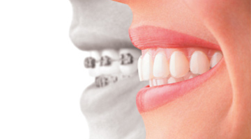 Appareils orthodontiques